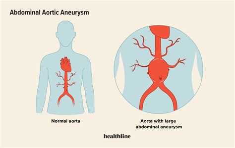 what are the symptoms of aaa